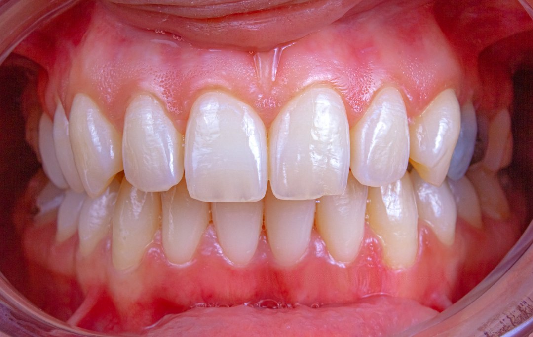 Periodontal Disease Stages: How Gum Disease Progresses and What You Can Do